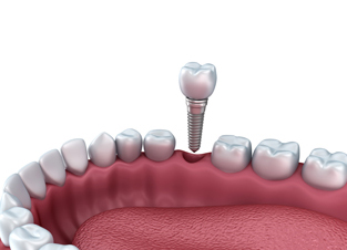 Dental implants in Clapham