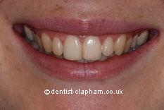 Amalgam Removals After