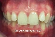 Amalgam Removals Before