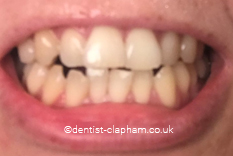 Teeth Before