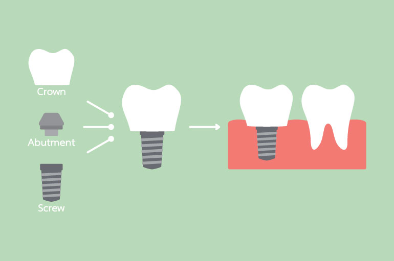 Dental implants in Clapham