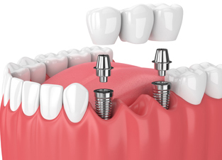Dental implants in Clapham
